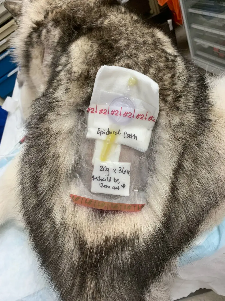 Epidural catheter placement for analgesia