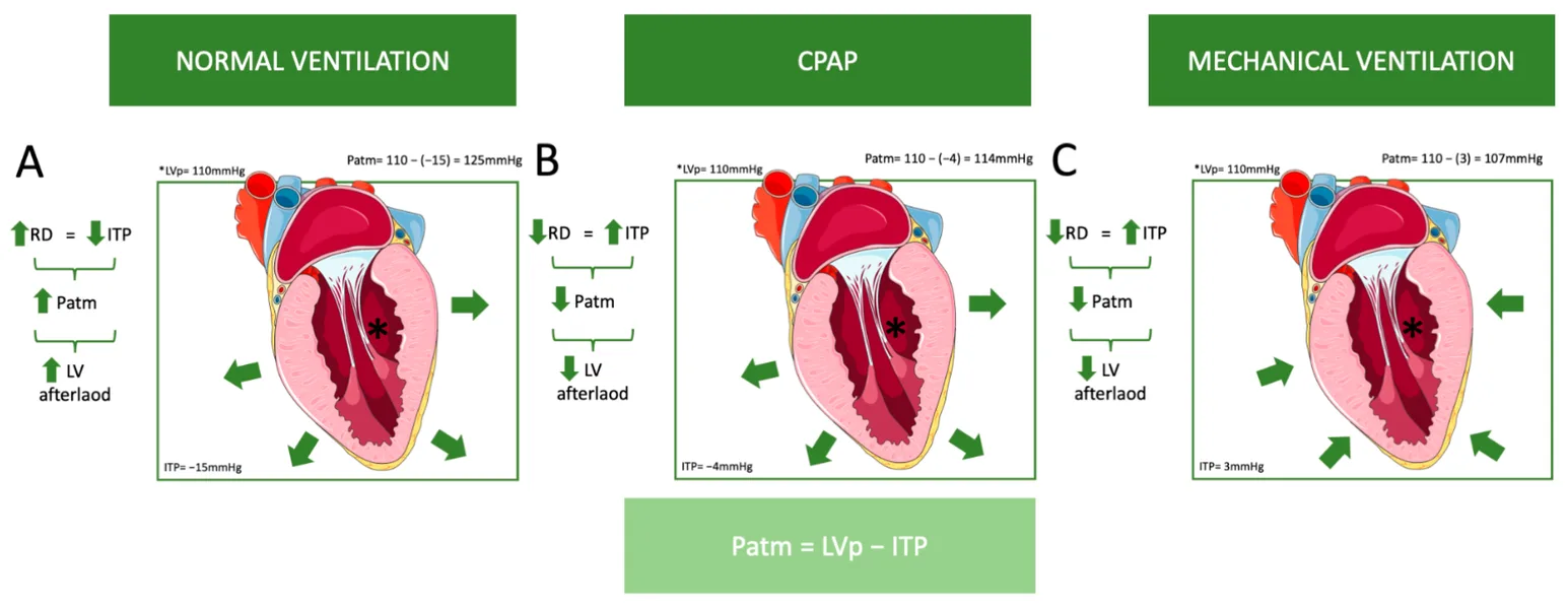 Diagram comparing hemodynamic effects of normal ventilation, CPAP, and mechanical ventilation on cardiac output and blood pressure